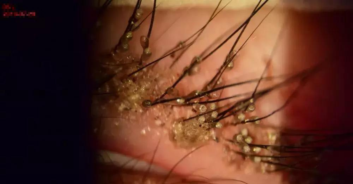 Indo Bokep Seorang bocah Pria berusia 4 tahun merasakan mata gatal, dan ibunya kaget ketika dokter minat sesuatu Nan “mengerikan” dari bagian dalam matanya.